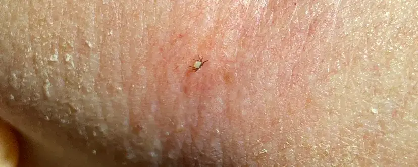 kleszcz wbity w skórę człowieka różne miejsca
