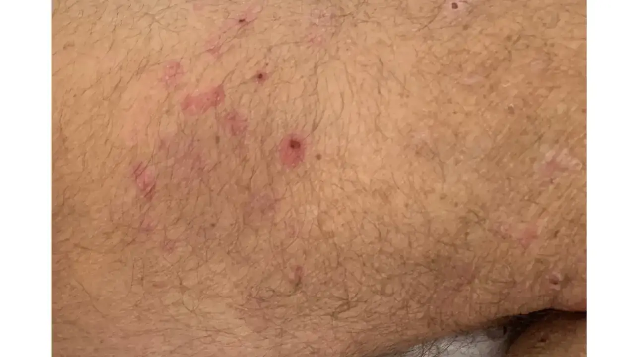 Piel con erupciones rojas y picaz&oacute;n, posibles s&iacute;ntomas de pulgas en la cama.