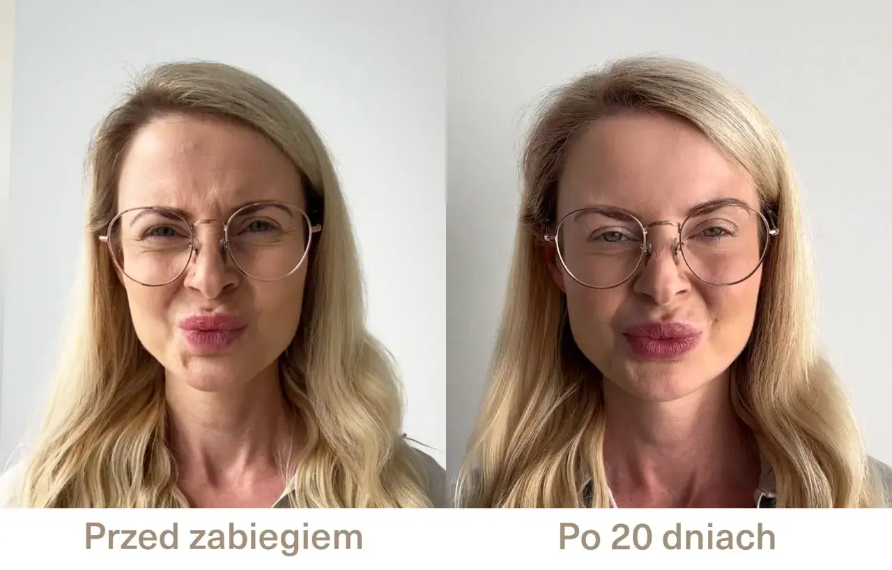 Przed zabiegiem widoczna głęboka lwia zmarszczka, po 20 dniach wygładzona.
