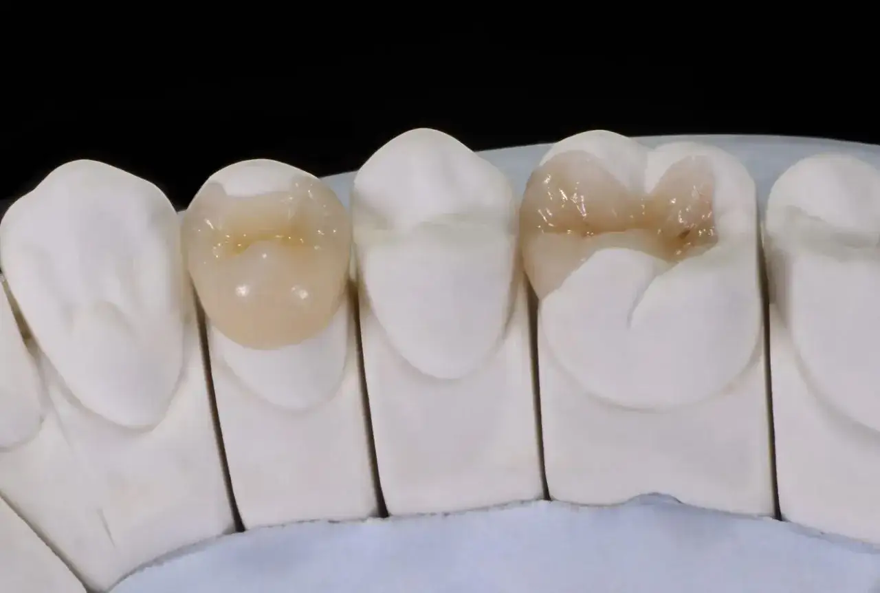 Modelos dentales muestran una incrustación cerámica dental, restaurando la forma y estética de los dientes.