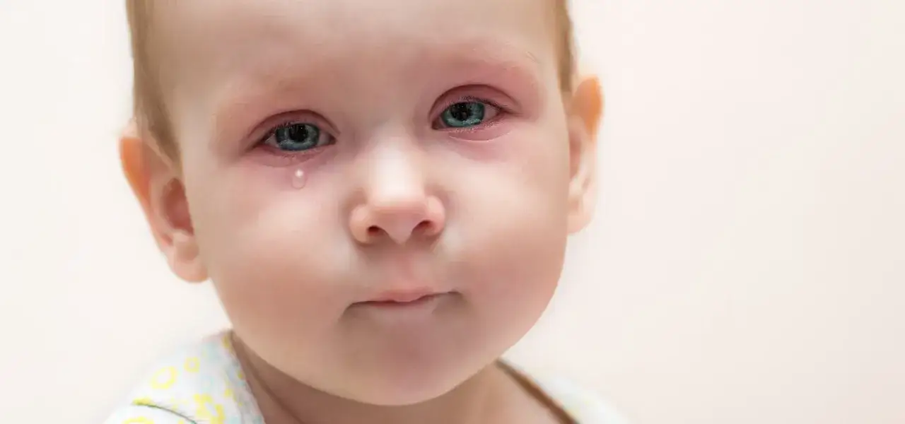 Ojos rojos e irritados de un beb&eacute;, con una l&aacute;grima cayendo. Posible conjuntivitis v&iacute;rica en el beb&eacute;.