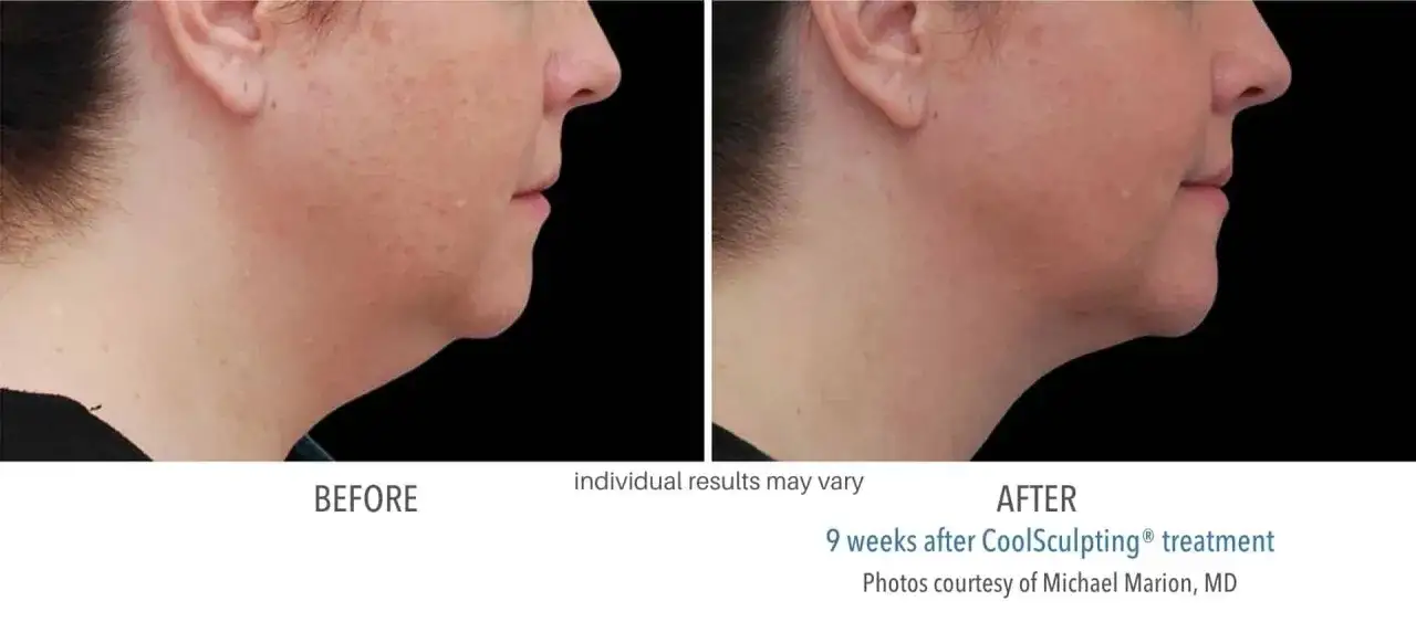 Före- och efterbilder som visar en minskning av fett under hakan efter CoolSculpting.