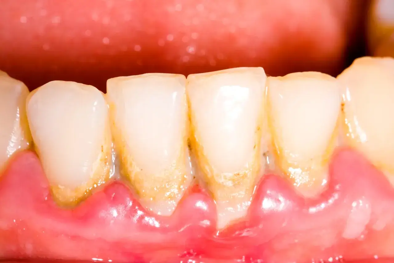 Dientes amarillentos y encías inflamadas, evidencia de dientes sin lavar y acumulación de sarro.