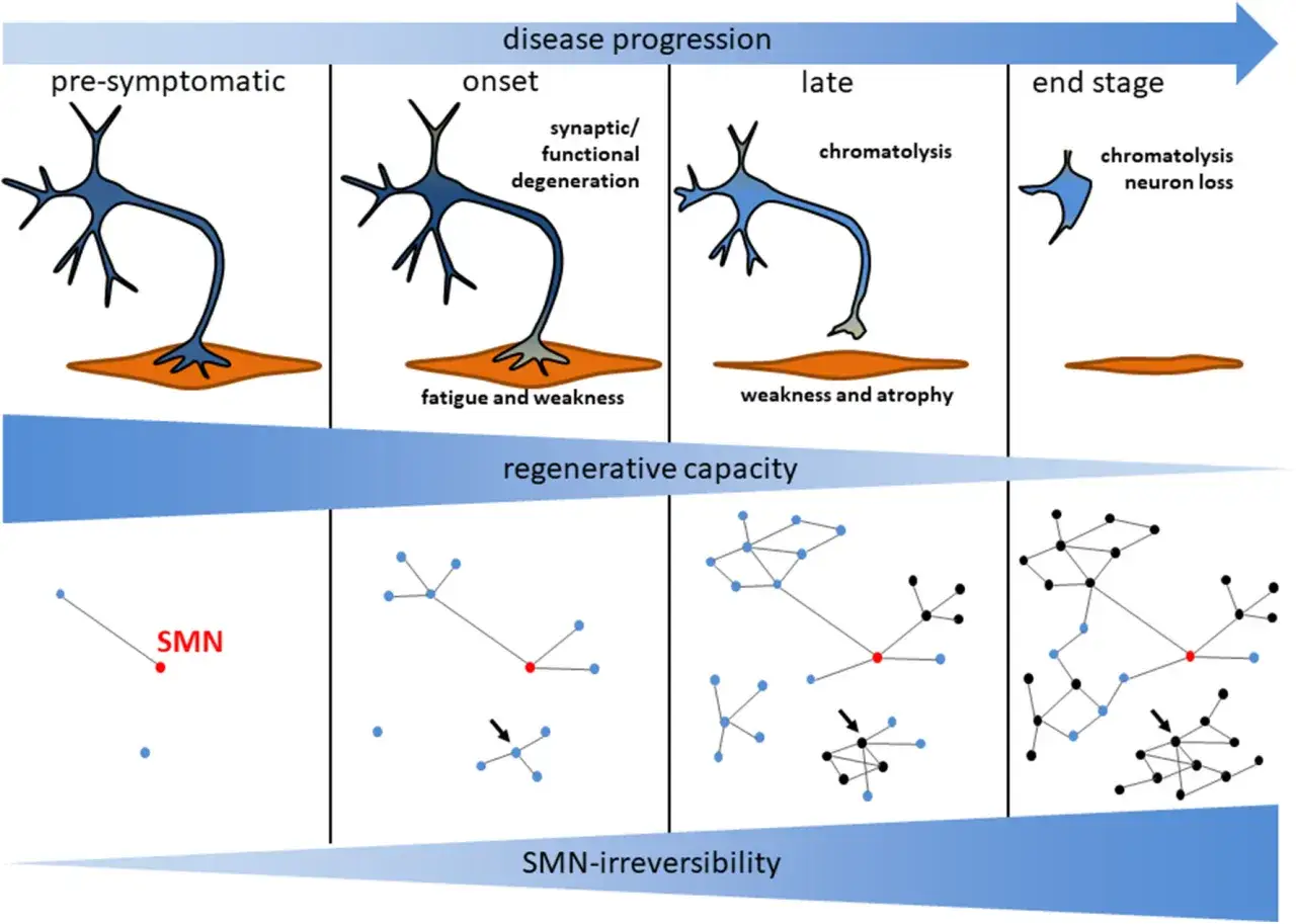 Ilustración de la progresión de la atrofia muscular espinal, mostrando degeneración neuronal y pérdida de capacidad regenerativa.
