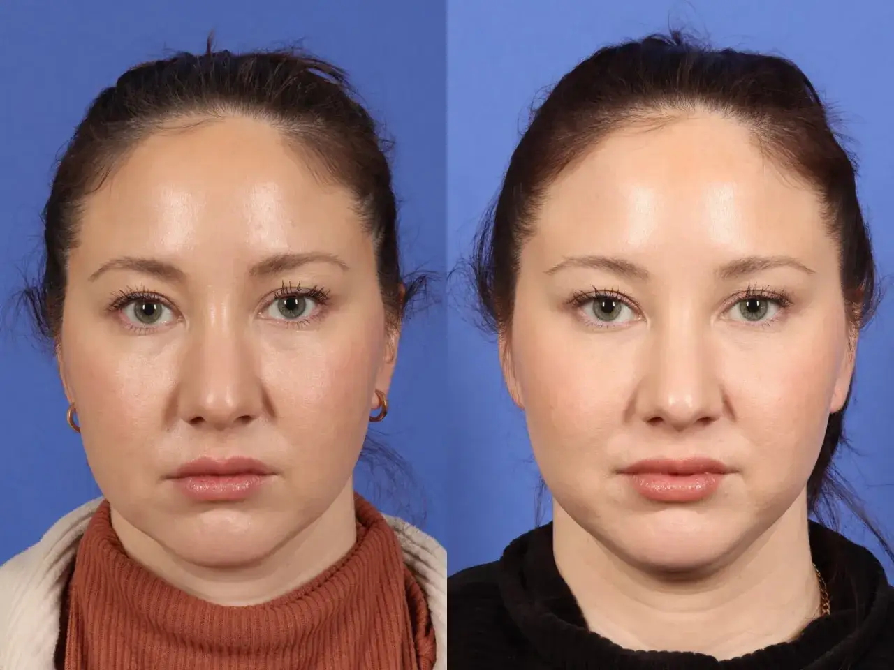 Confronto prima/dopo di un trattamento estetico. La pelle appare pi&ugrave; liscia e distesa, suggerendo un effetto duraturo. Quanto dura il botox?