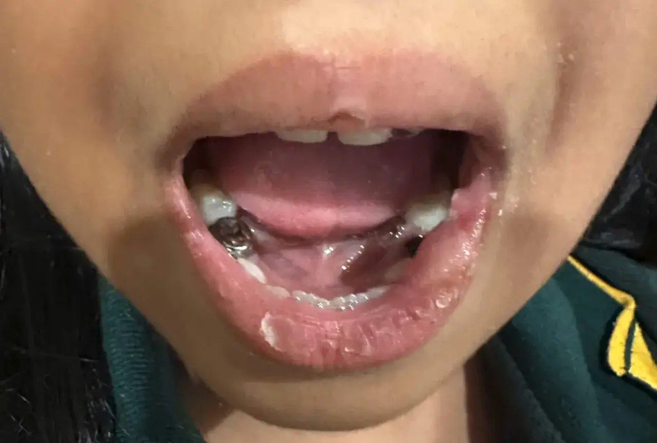 Usta z widocznymi zębami i metalowymi wypełnieniami. Gdy znieczulenie nie schodzi, warto skonsultować się z dentystą.