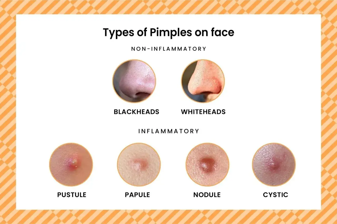 Illustration des diff&eacute;rents types de bouton visage : points noirs, points blancs, pustule, papule, nodule et kyste.