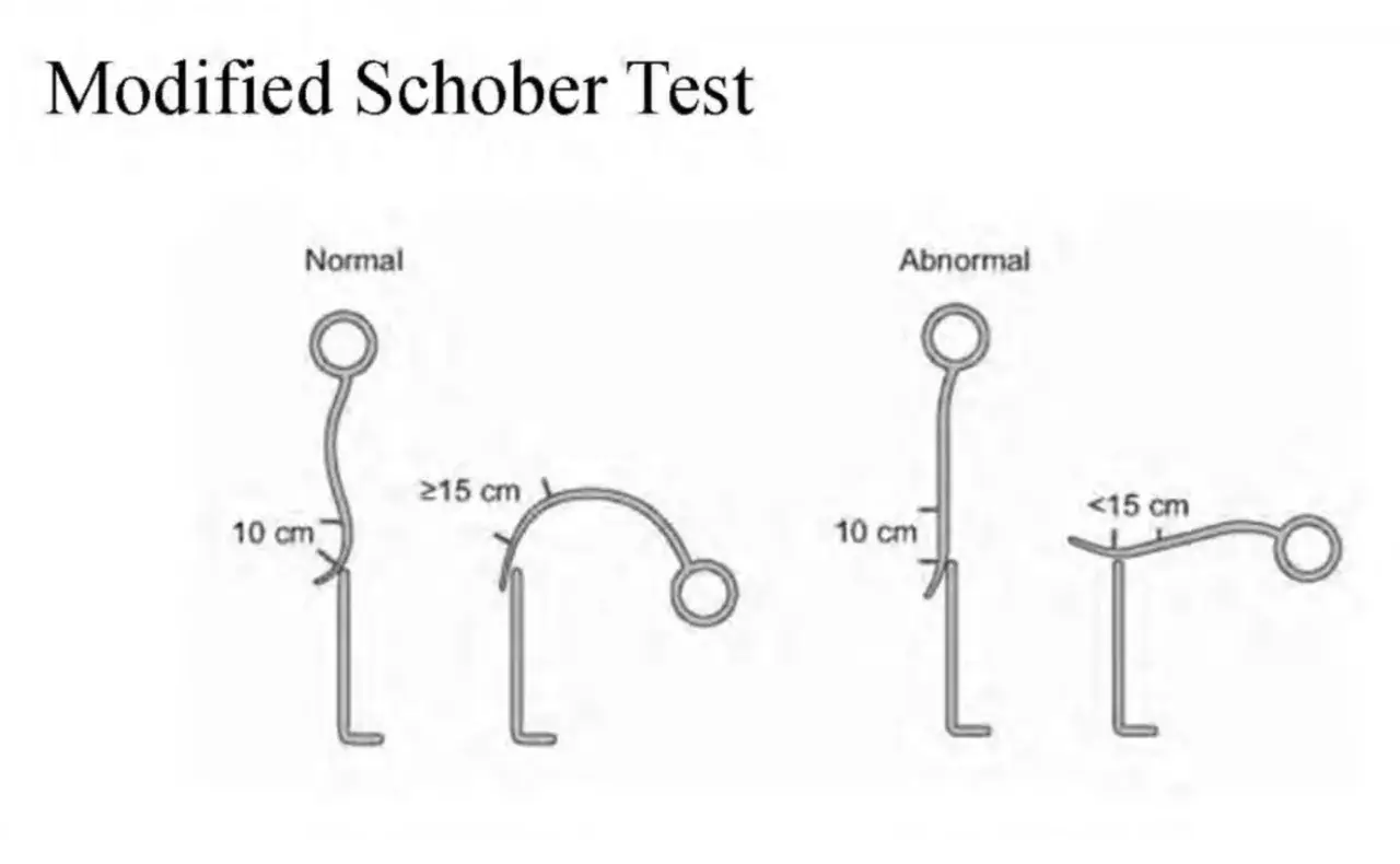 Der modifizierte Schober Test zeigt die Messung der Beweglichkeit der Lendenwirbelsäule. Normal: über 15 cm. Abnorm: unter 15 cm.