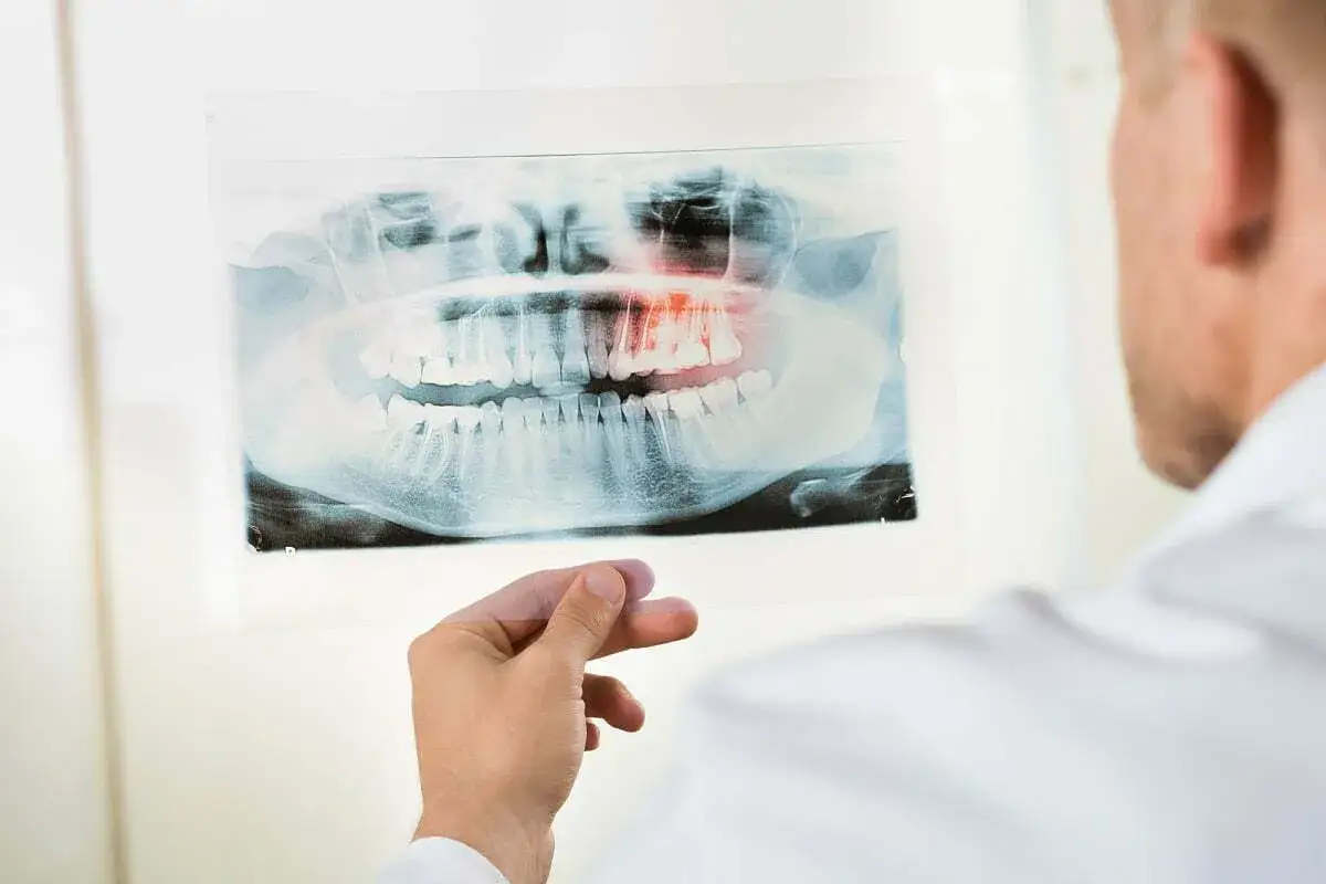 Dentysta analizuje zdjęcie RTG szczęki, gdzie czerwony obszar wskazuje na torbiel w zębie.