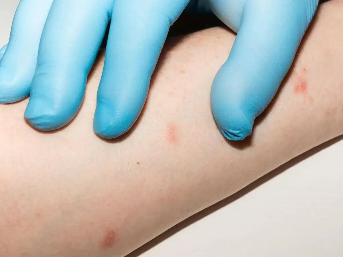 Mano con guanto blu esamina piccole lesioni cutanee rosse su un braccio, indicative di psoriasi guttata nei bambini.
