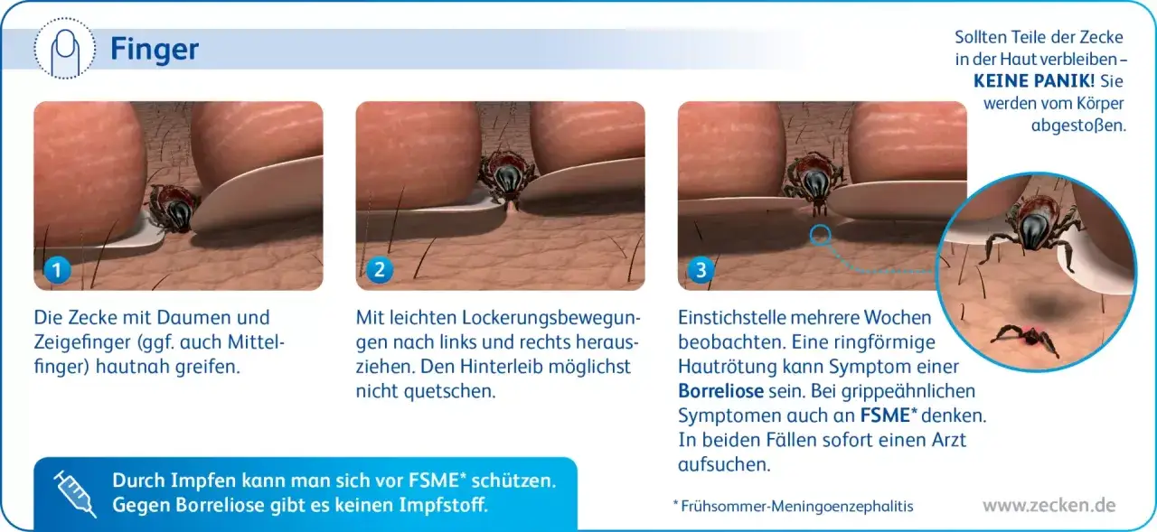 Zeckenbiss-Entfernung: Zecke greifen, locker herausziehen, Stichstelle beobachten. Bei Rötung Borreliose, bei grippalen Symptomen FSME möglich.