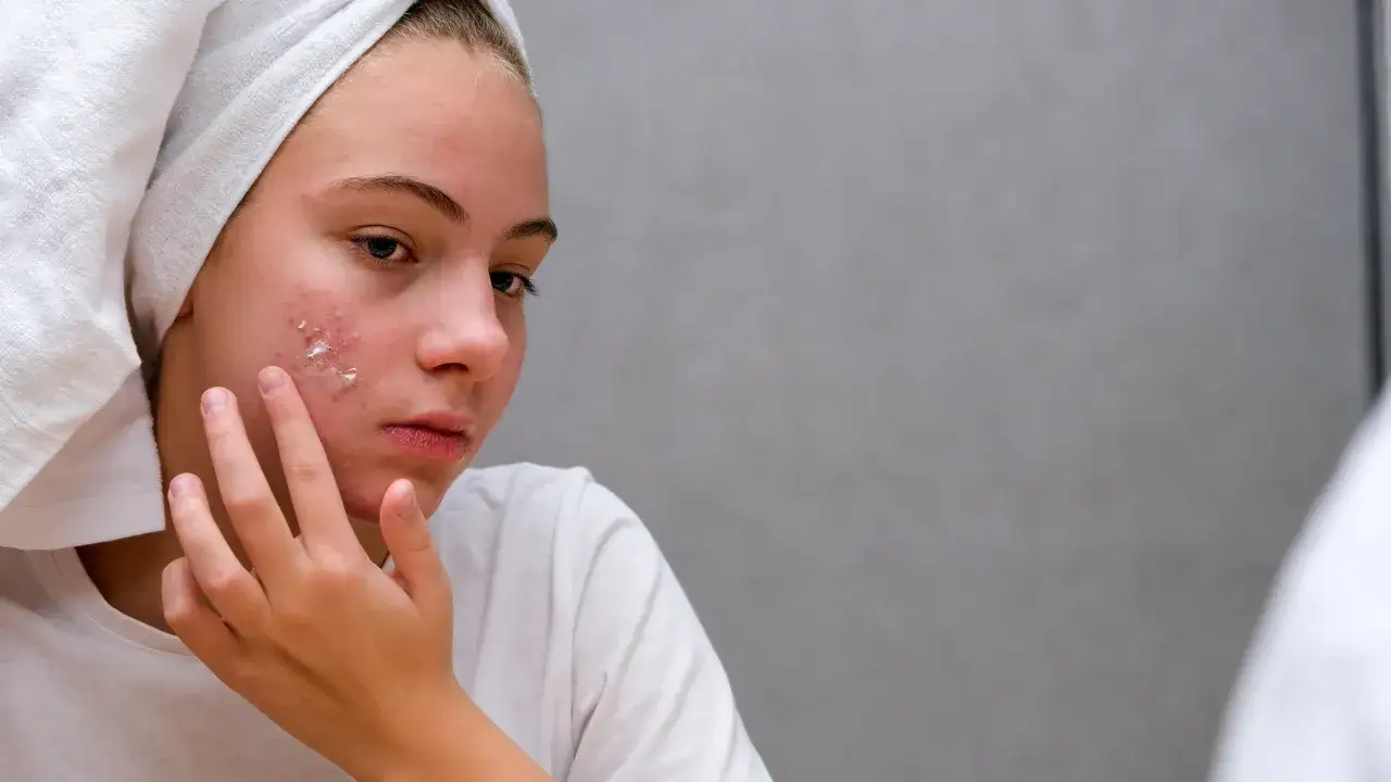 Dziewczyna z ręcznikiem na głowie aplikuje krem na trądzikową skórę. Klindacin t pomaga jej w walce z niedoskonałościami.