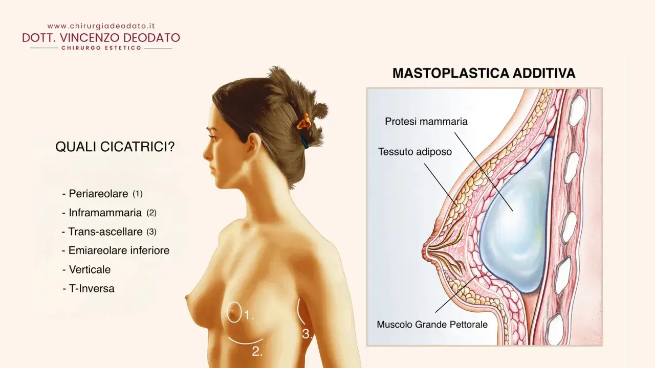 Illustrazione anatomica della mastopessi additiva, con dettagli su protesi mammaria, tessuto adiposo e cicatrici.