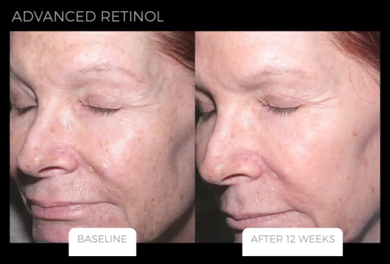 Comparaison avant apr&egrave;s : peau rid&eacute;e et tachet&eacute;e avant, peau plus lisse et uniforme apr&egrave;s 12 semaines de traitement au retinol avanc&eacute;.