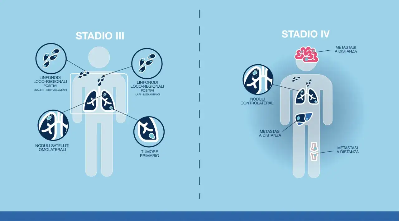 Stadio IV: il tumore primario ha metastasi a distanza nel cervello, fegato e ossa.