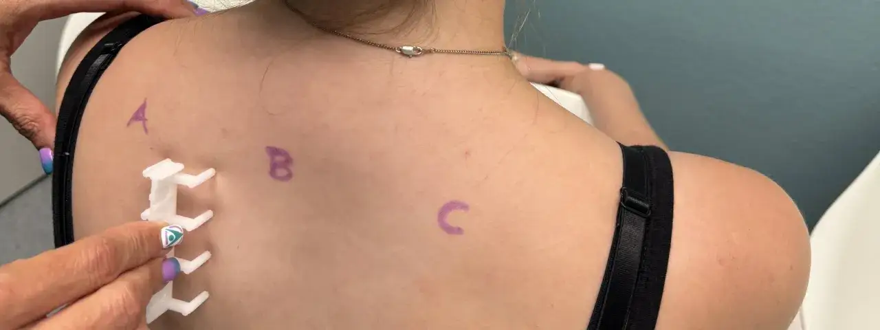 En person får ett allergi test på ryggen. Märken med bokstäverna A, B och C syns på huden.