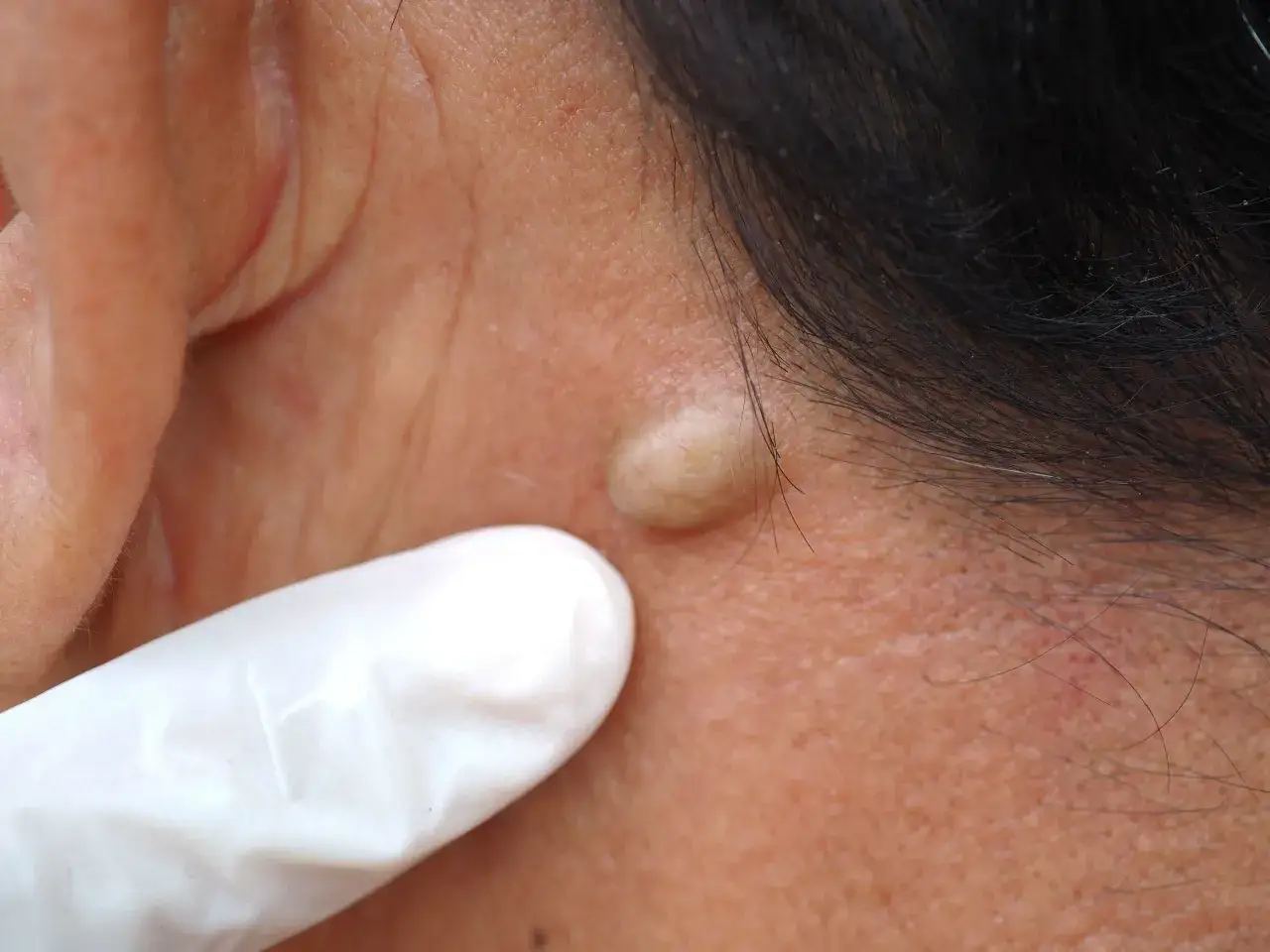 Un dedo enguantado se&ntilde;ala un grano enquistado en la piel, cerca de la l&iacute;nea del cabello.