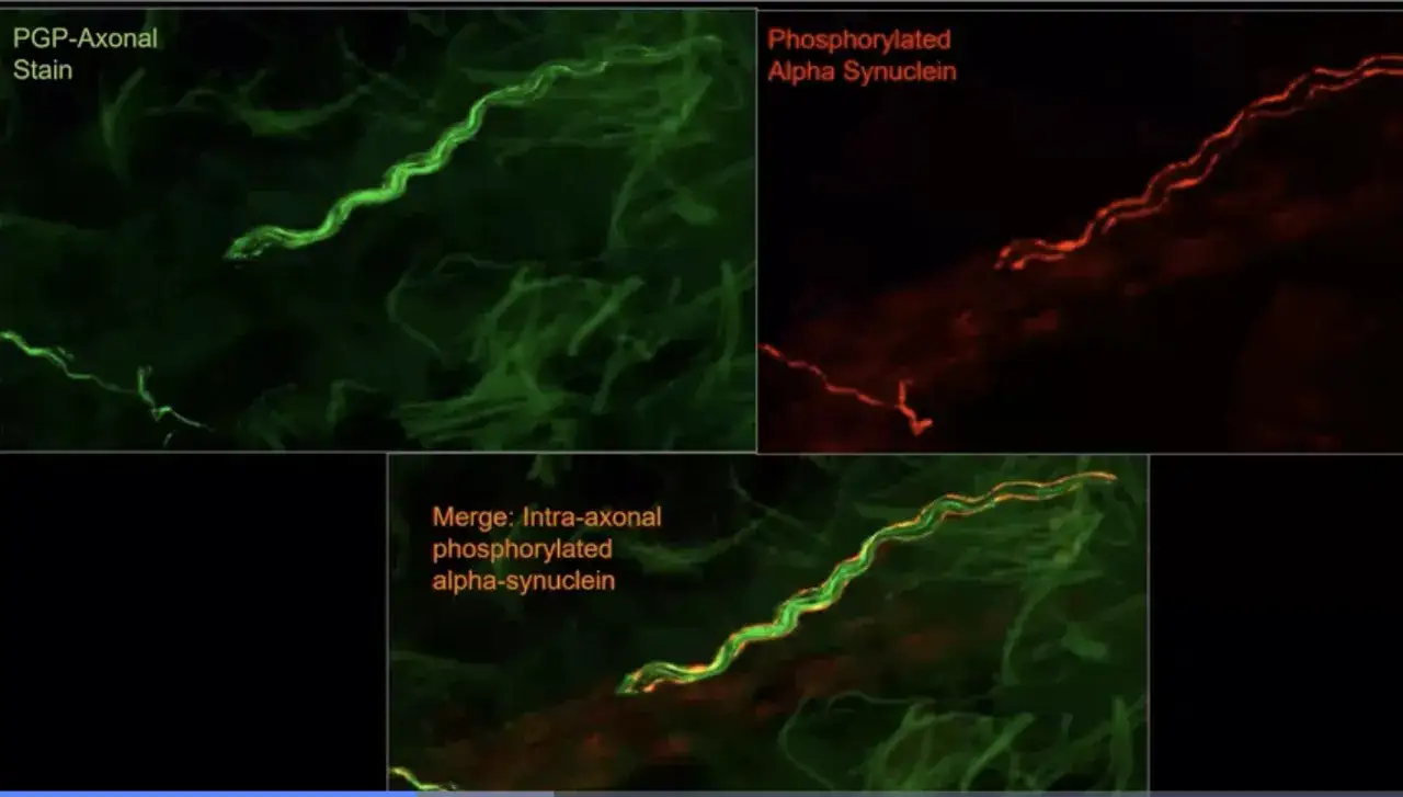 Mikroskopische Aufnahme von Nervenfasern, die für Parkinson-Tests relevant sind. Grün zeigt Axone, Rot phosphoryliertes Alpha-Synuklein.