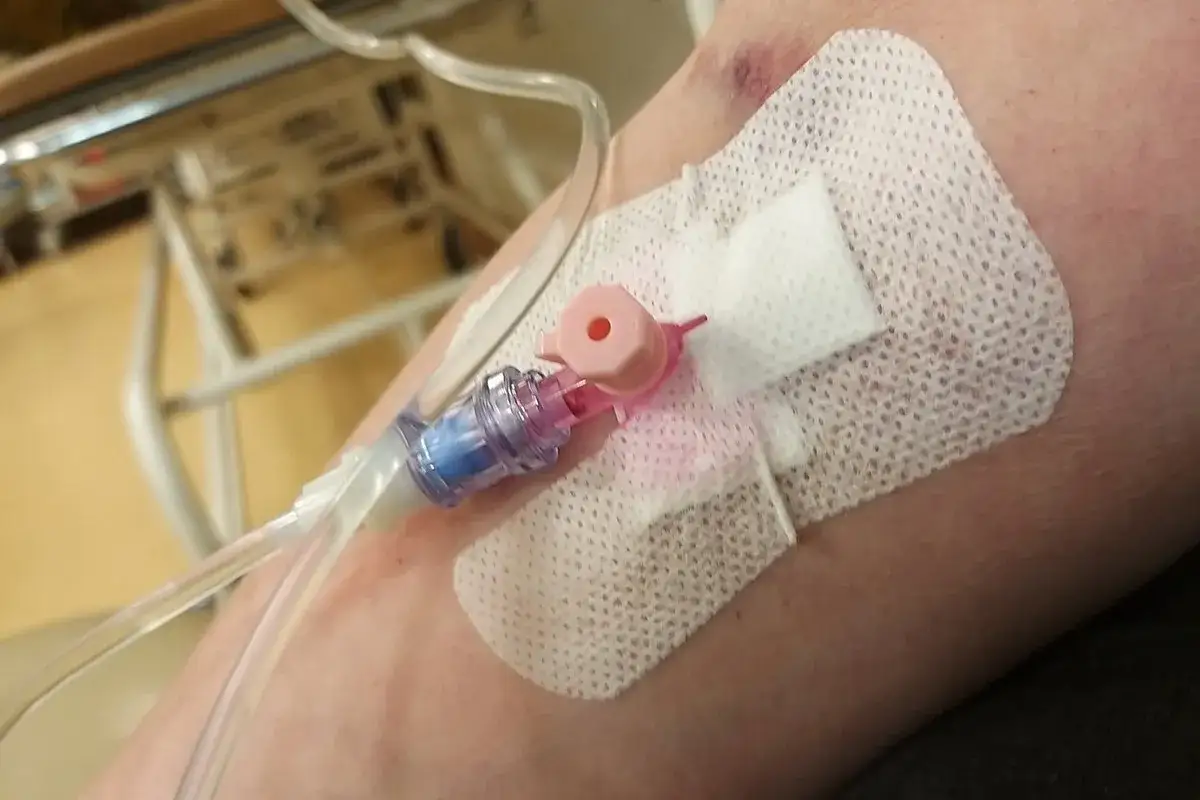 Różne rodzaje chemii kolory – wenflon z różowym i niebieskim elementem, podłączony do kroplówki na ramieniu.