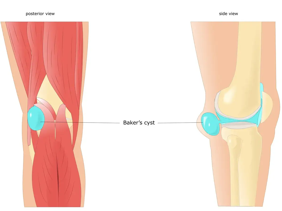 Anatomia kolana z widoczną torbielą Bakera z tyłu i z boku.