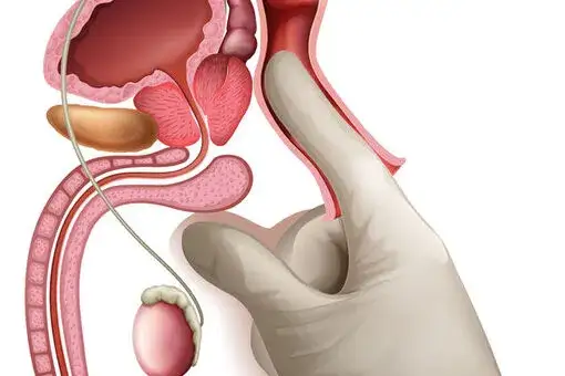 objawy urologiczne u mężczyzn grafika