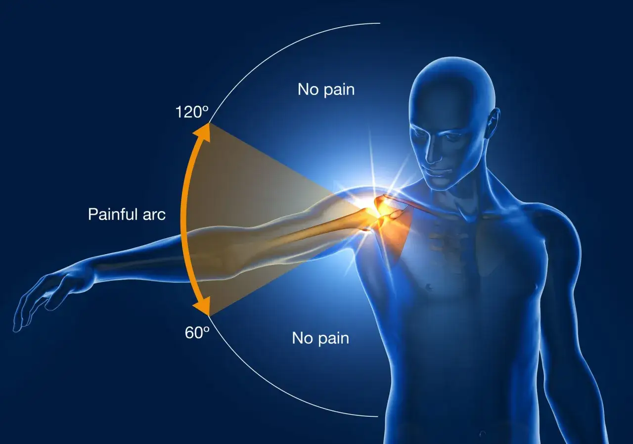 An anatomical illustration showing the painful arc of swimmer's shoulder, from 60° to 120° of arm abduction.
