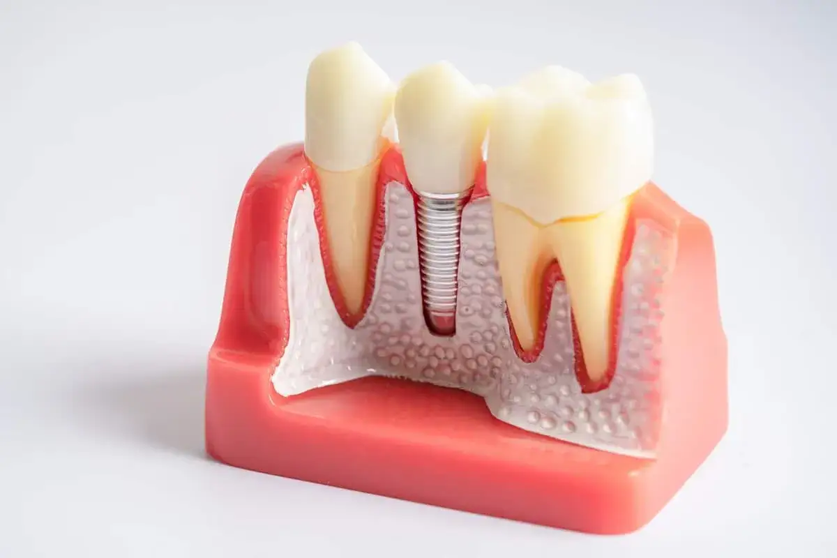 Modello dentale con impianto, che mostra come il cibo possa accumularsi sotto un impianto dentale se non pulito correttamente.