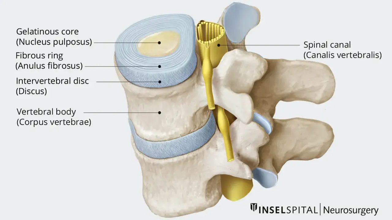 Anatomia kręgosłupa: uszkodzenie pierścienia włóknistego krążka międzykręgowego, z widocznym rdzeniem galaretowatym i kanałem kręgowym.