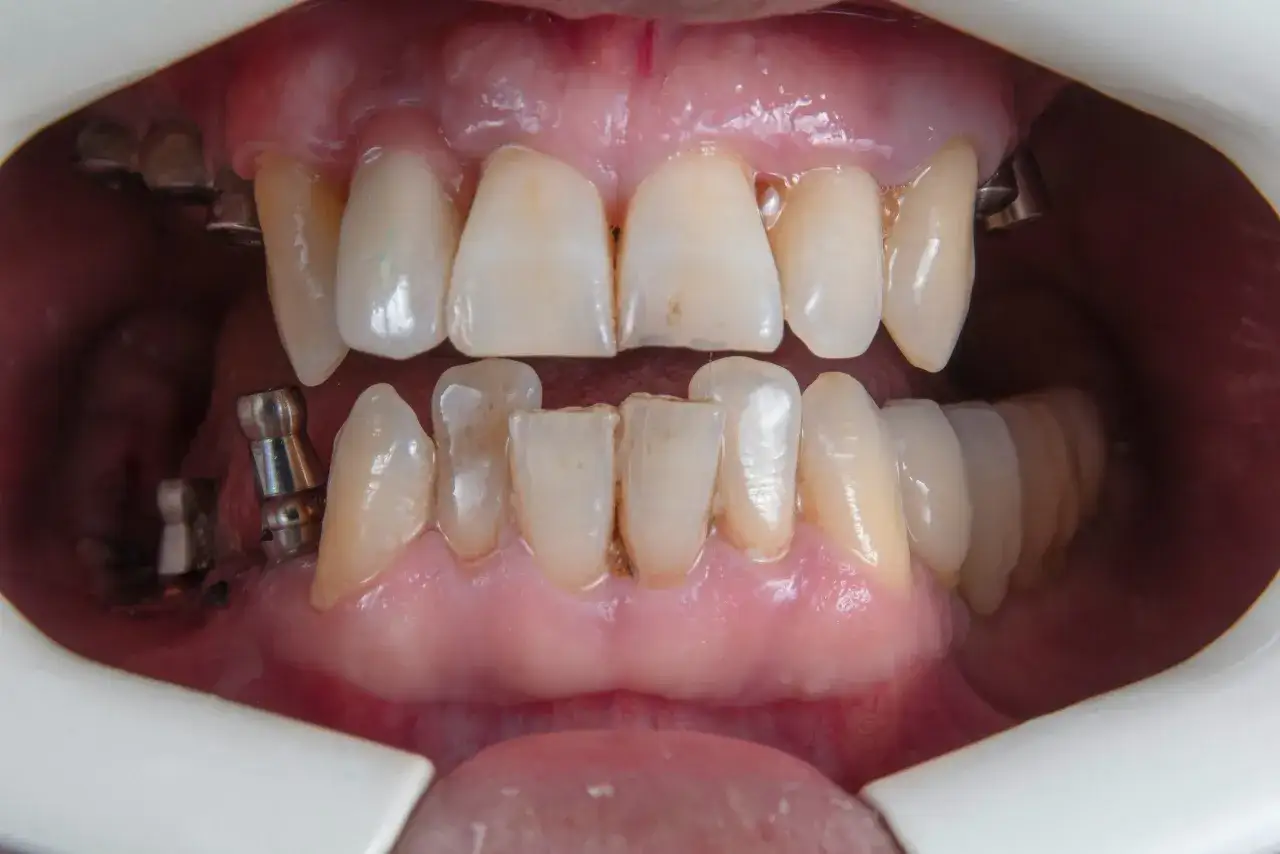 Denti con corone e impianti visibili. Alcuni denti mostrano segni di usura e la dentina esposta, indicando la necessità di cure.