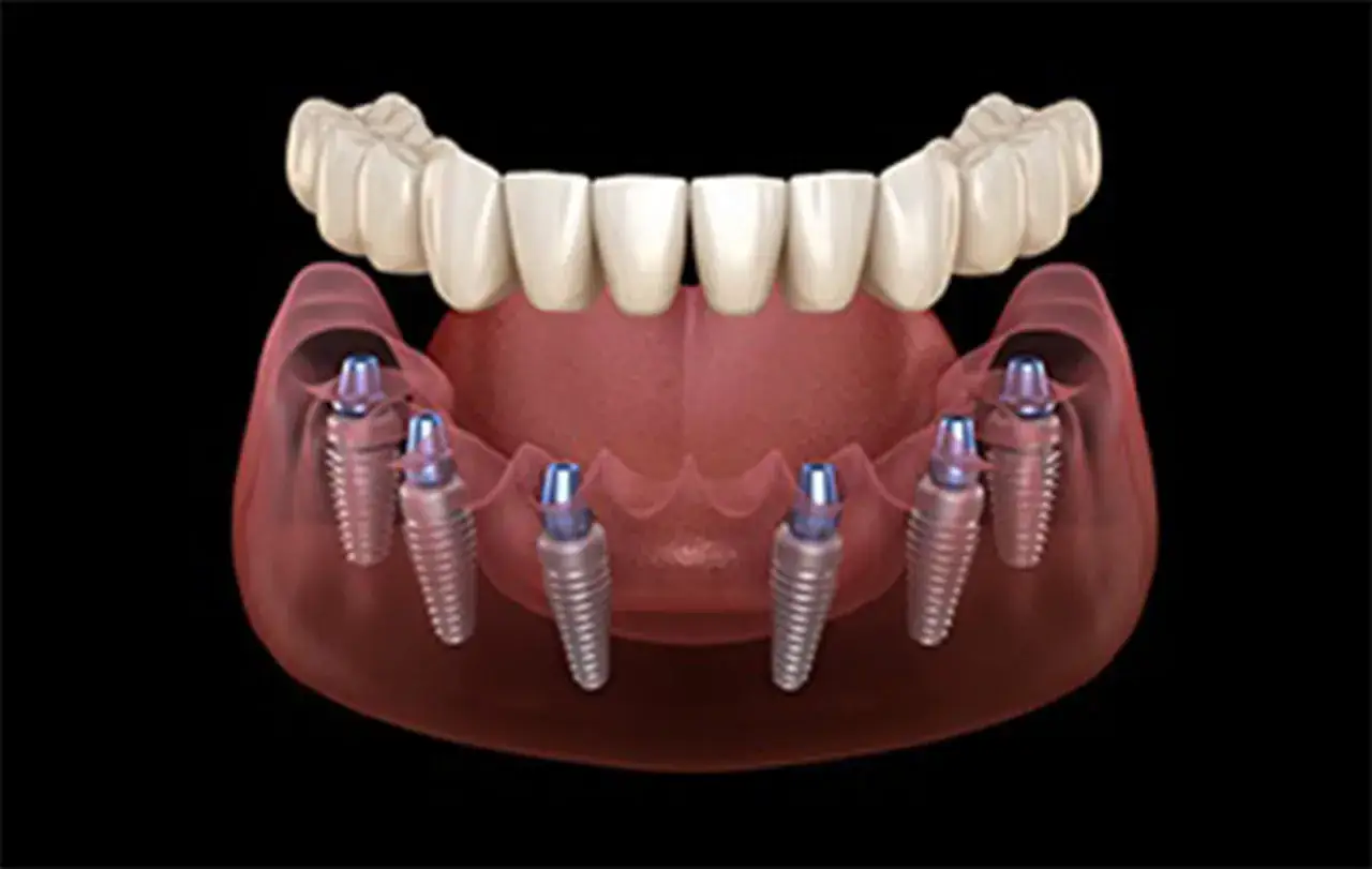 Modello 3D di un impianto dentale all on four, con sei viti inserite nell'arcata inferiore e una protesi dentale superiore.