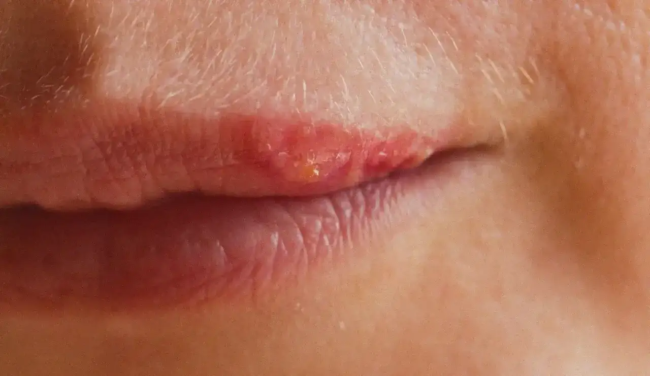 Gros plan sur une l&egrave;vre sup&eacute;rieure pr&eacute;sentant un bouton de fi&egrave;vre rouge et enflamm&eacute;, signe qu'un rem&egrave;de bouton de fi&egrave;vre est n&eacute;cessaire.