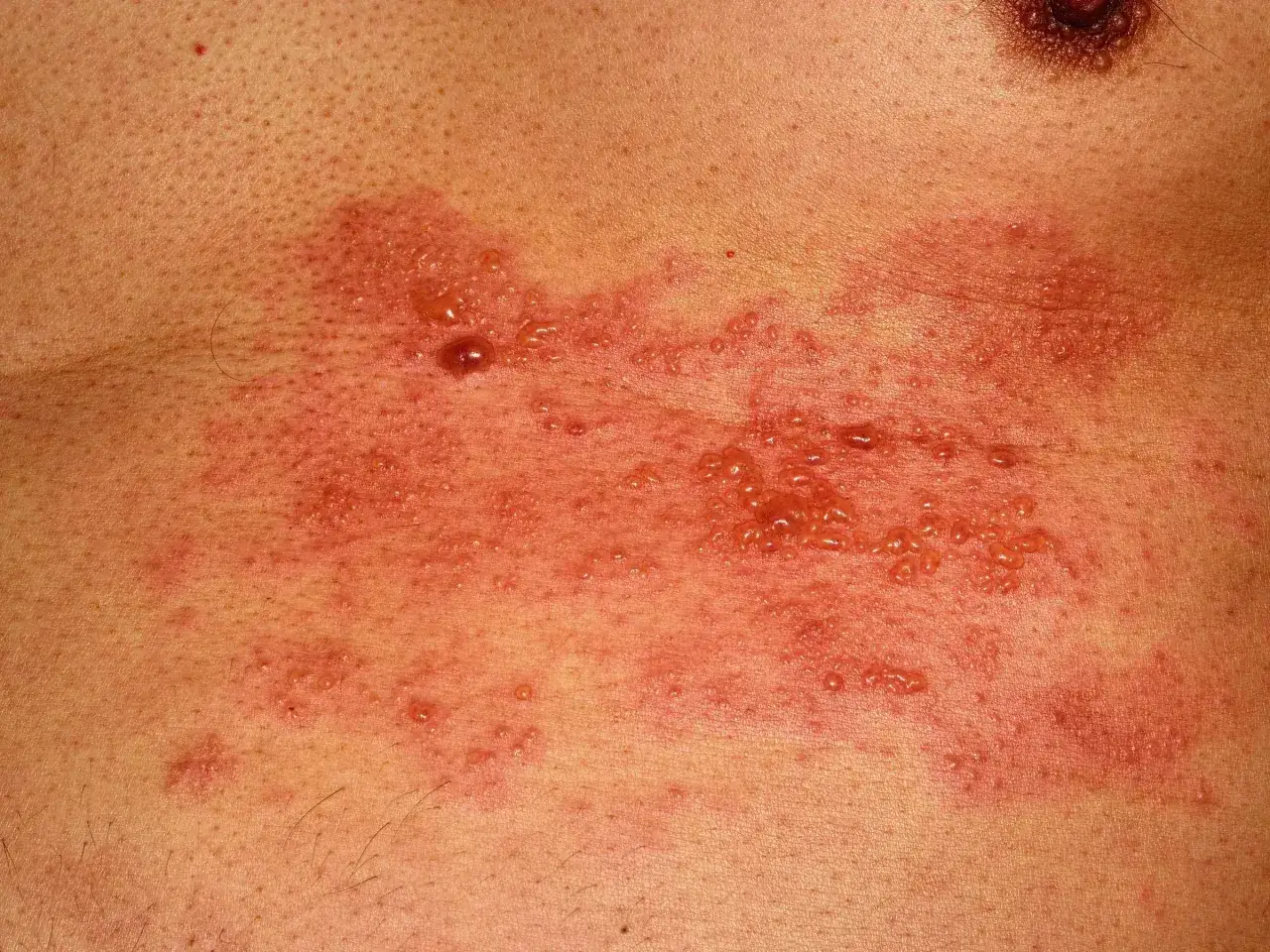 Hautausschlag mit Bl&auml;schen auf der Brust, m&ouml;glicherweise im Zusammenhang mit Corona.
