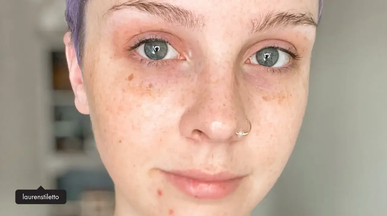 N&auml;rbild p&aring; en person med bl&aring;gr&ouml;na &ouml;gon, fr&auml;knar och en n&auml;sring. Huden har naturlig melanin och n&aring;gra sm&aring; finnar.