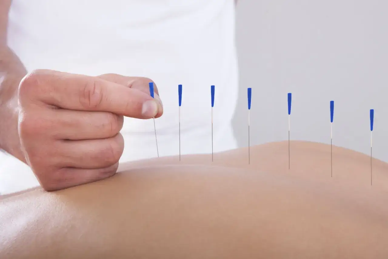Un terapeuta coloca agujas finas en la espalda de un paciente, ilustrando cómo funciona la acupuntura para aliviar el dolor y promover el bienestar.