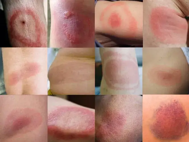 Jak wygląda rumień wędrujący po kleszczu