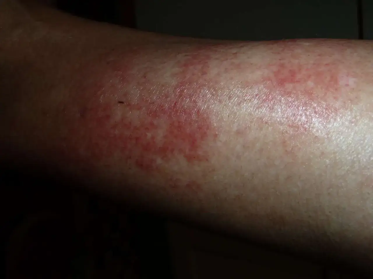 Éruption cutanée rouge sur un bras, possiblement un purpura d'effort après une activité physique intense.