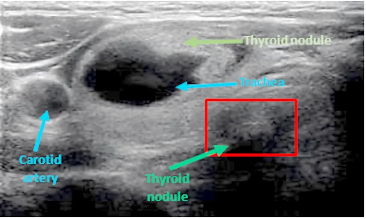 Ultraschallbild zeigt Schilddrüse mit Knoten. Die Carotisarterie und die Trachea sind ebenfalls sichtbar. Ein Bereich mit calcitonin-produzierendem Gewebe in der Schilddrüse ist markiert.