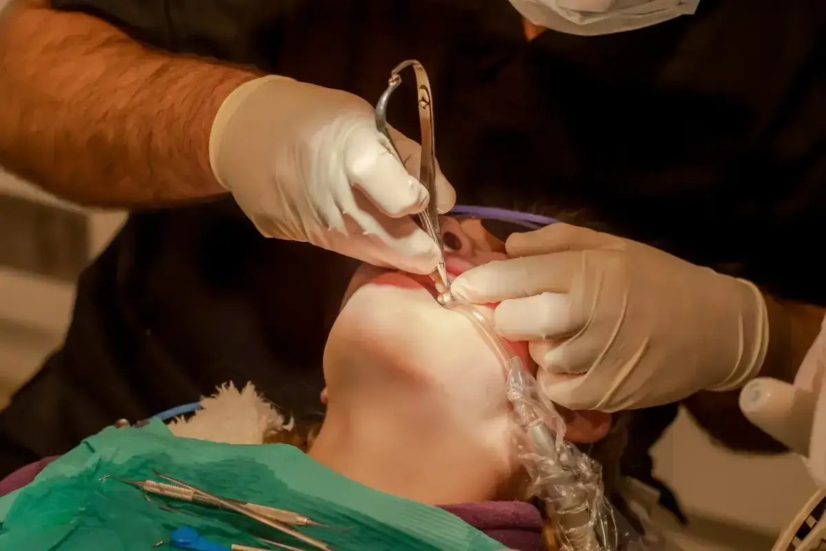 Ortodonta wyrywa zęby, używając specjalistycznych narzędzi. Pacjent leży na fotelu dentystycznym, a zabieg jest przeprowadzany w znieczuleniu.