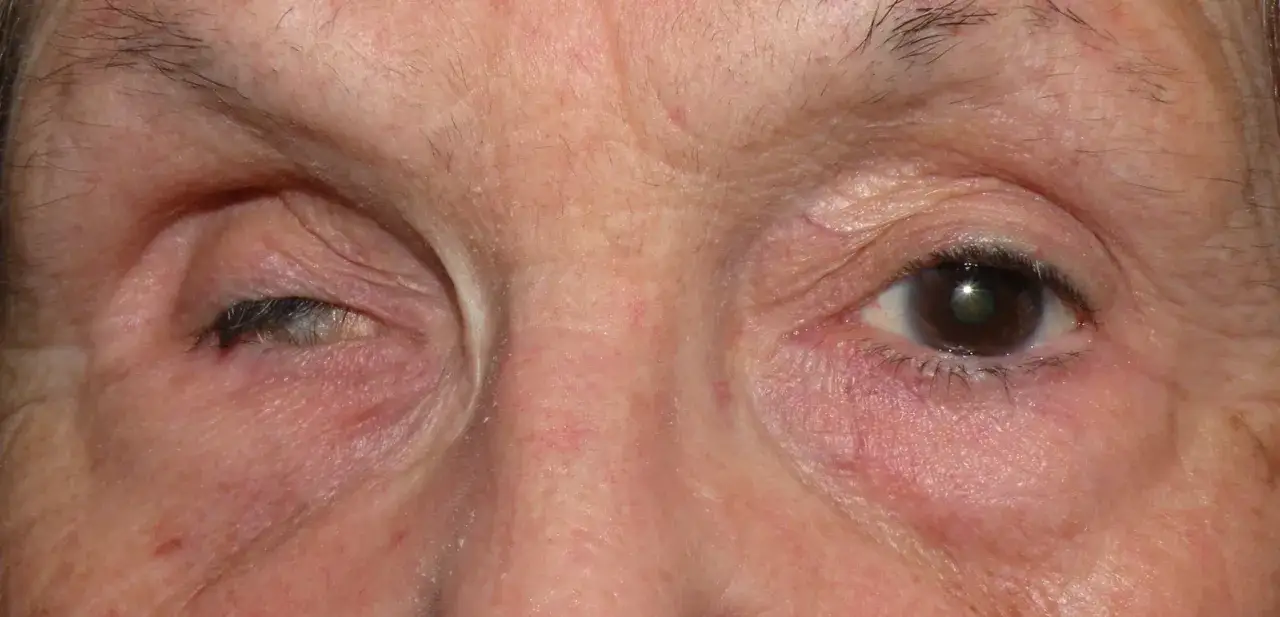 Primo piano degli occhi di una persona. L'occhio sinistro mostra segni di atrofia oculare, con la palpebra abbassata. L'occhio destro appare normale.