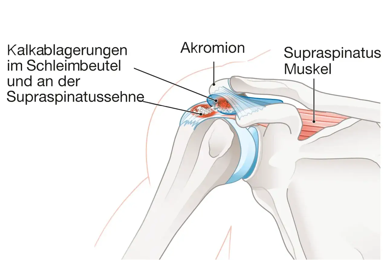 Kalkablagerungen im Schleimbeutel und an der Supraspinatussehne: Was tun bei Kalkschulter? Anatomie der Schulter.