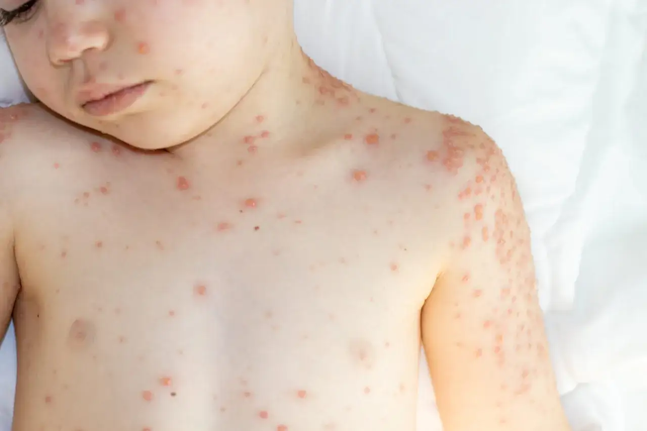 Rodzic konsultuje się z pediatrą w sprawie wysypki u dziecka