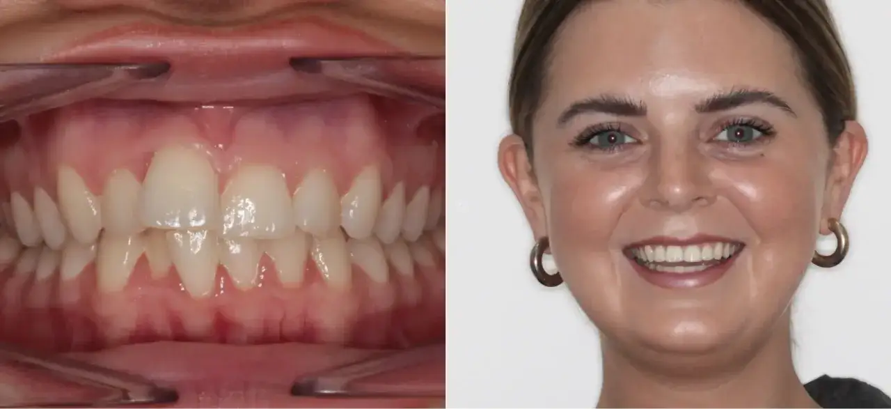 Sonrisa transformada con Invisalign mes a mes. Antes y después de un tratamiento de ortodoncia invisible.