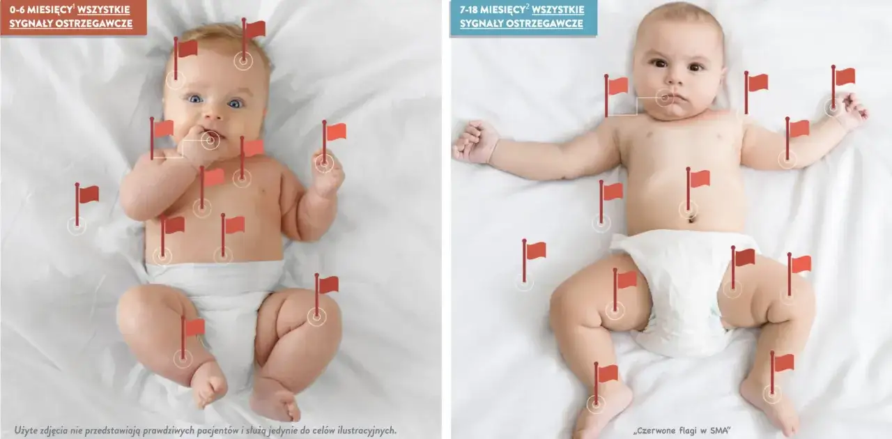 Dwa niemowlęta z czerwonymi flagami oznaczającymi sygnały ostrzegawcze w SMA. Starsze dziecko ma więcej flag, co sugeruje postęp choroby.