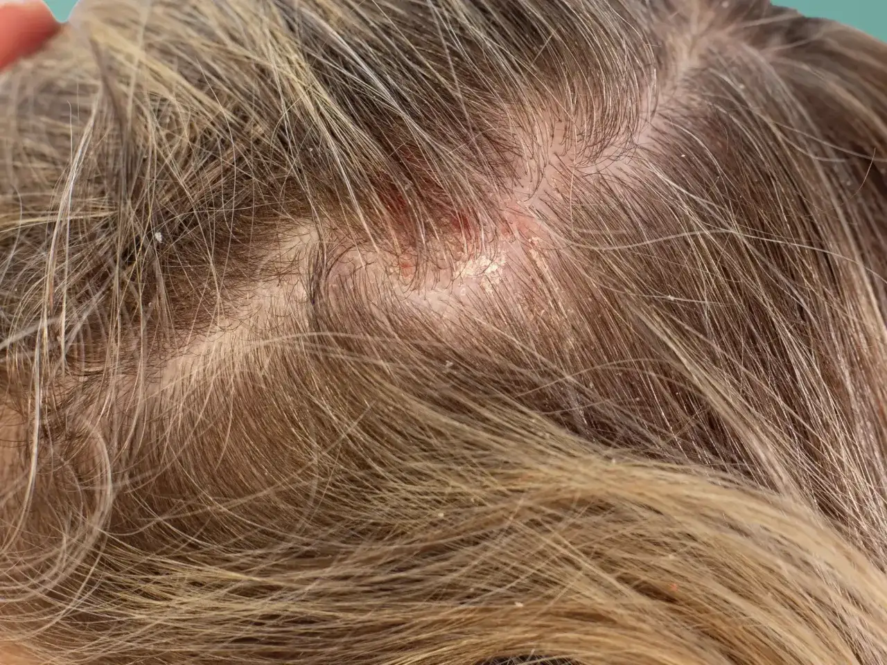 Nahaufnahme der Kopfhaut mit Haaren, die einen roten, schuppigen Bereich zeigen, der auf **Schorf am Hinterkopf** hindeutet.