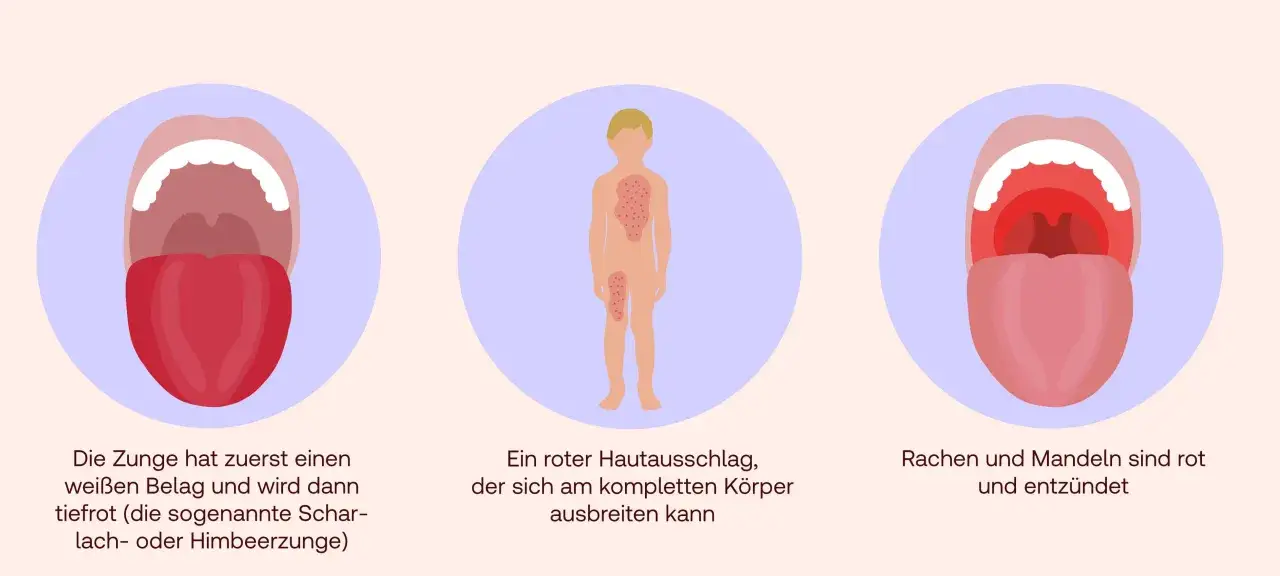 Scharlach: Zunge mit Belag, Hautausschlag, entz&uuml;ndeter Rachen. Wichtige Symptome, auch bei scharlach schwangerschaft zu beachten.