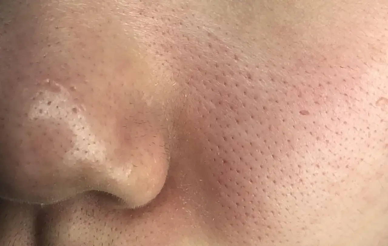Gros plan sur la peau du nez, montrant des pores dilatés et des filaments sébacés.