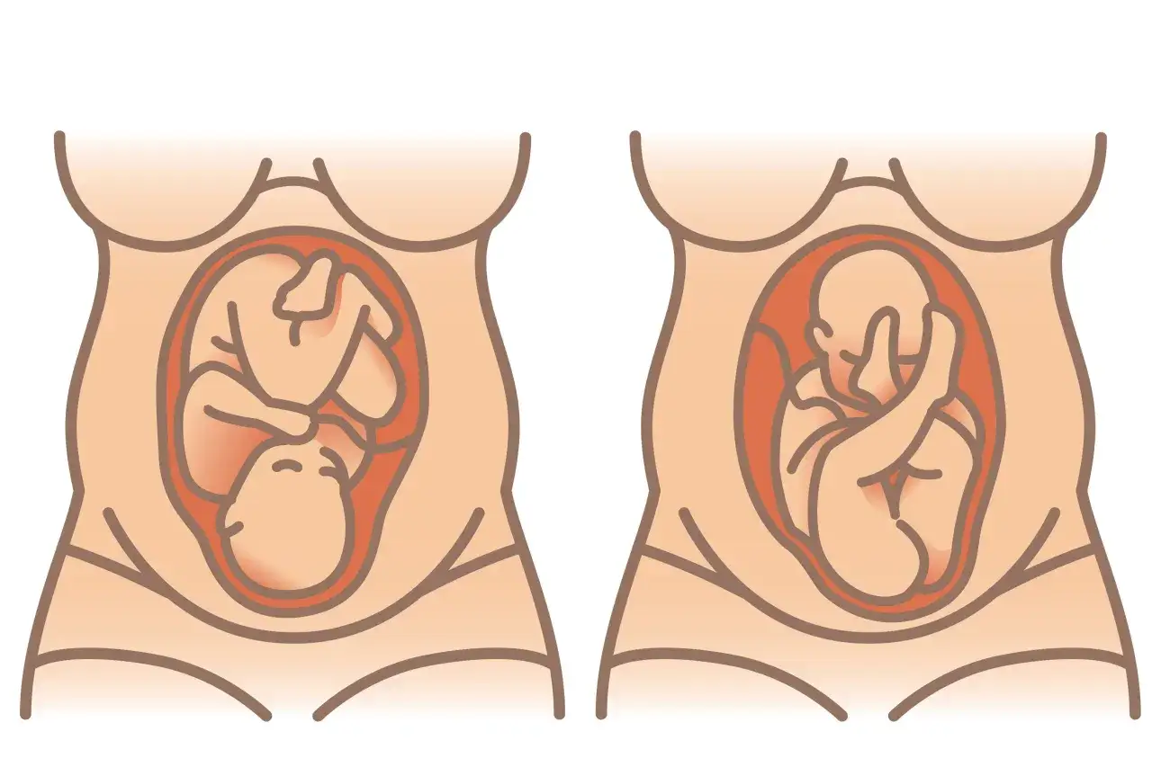Zwei Darstellungen eines schwangeren Bauches. Links liegt das Baby mit dem Kopf nach unten, rechts mit dem Kopf nach oben. Dies kann auf verschiedene Anzeichen f&uuml;r die Geburt hindeuten.