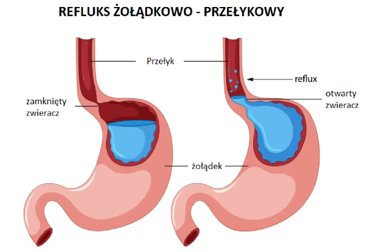Ilustracja pokazuje refluks żołądkowo-przełykowy. Po lewej zamknięty zwieracz, po prawej otwarty zwieracz i cofanie się treści żołądkowej.