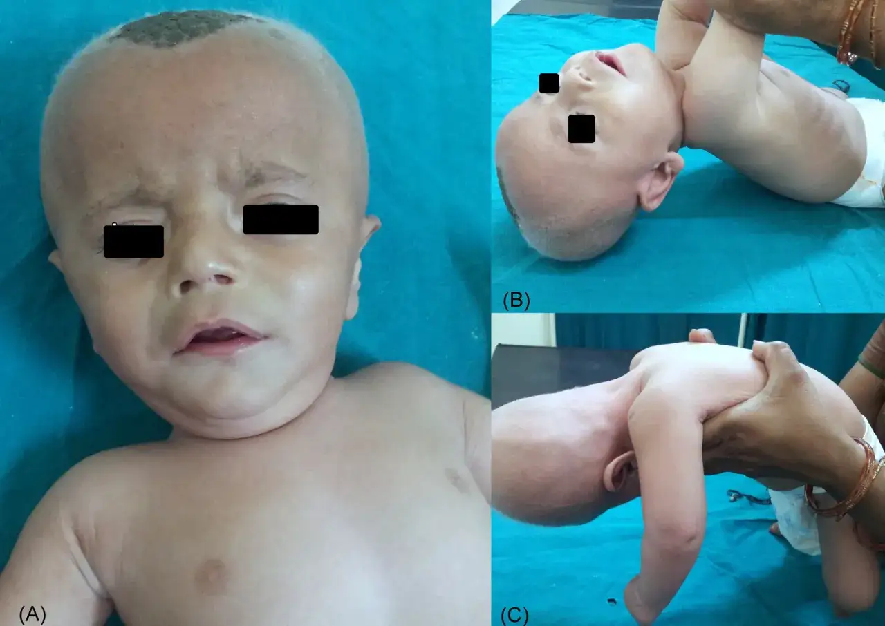 Beb&eacute; con rasgos faciales caracter&iacute;sticos de la enfermedad de Menkes, incluyendo piel fina y cabello escaso. Las im&aacute;genes (B) y (C) muestran hipotonia.