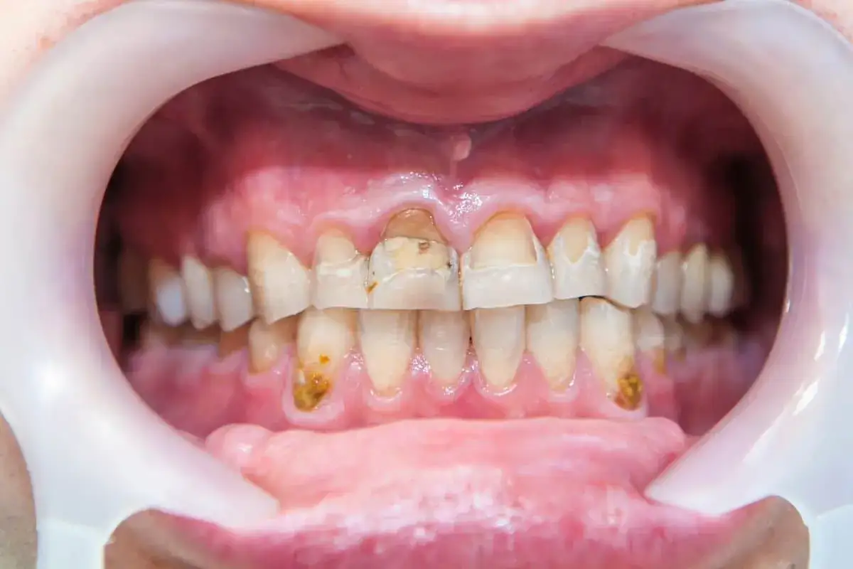Denti ingialliti e cariati, con evidenti macchie scure. Un esempio di come il t&egrave; macchia i denti, compromettendone la salute e l'estetica.